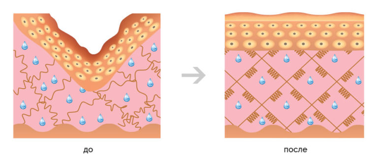 Одновременное воздействие коллагена и гиалуроновой кислоты оказывает на кожу выраженное регенерирующее и омолаживающее действие.